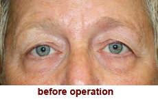 plastic-surgery-blepharoplasty